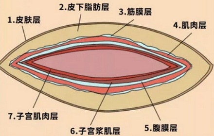 为啥剖腹产要用手撕成大口，而不是用刀切开？