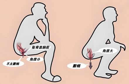 为什么建议蹲着上厕所？