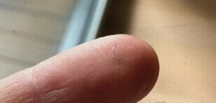 为什么手术中护士最怕听到主刀医生说 10-0 的针掉了?