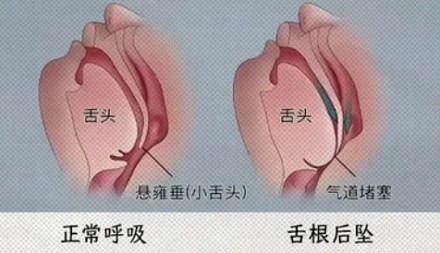 为什么手术结束后，不能随便睡觉？