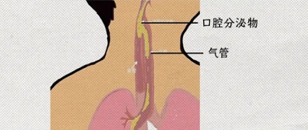为什么手术结束后，不能随便睡觉？