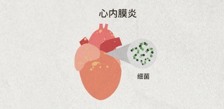 为什么做心脏手术前要先洗牙?
