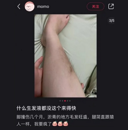 为什么伤口愈合后会长毛？那头皮受伤也能生发吗？